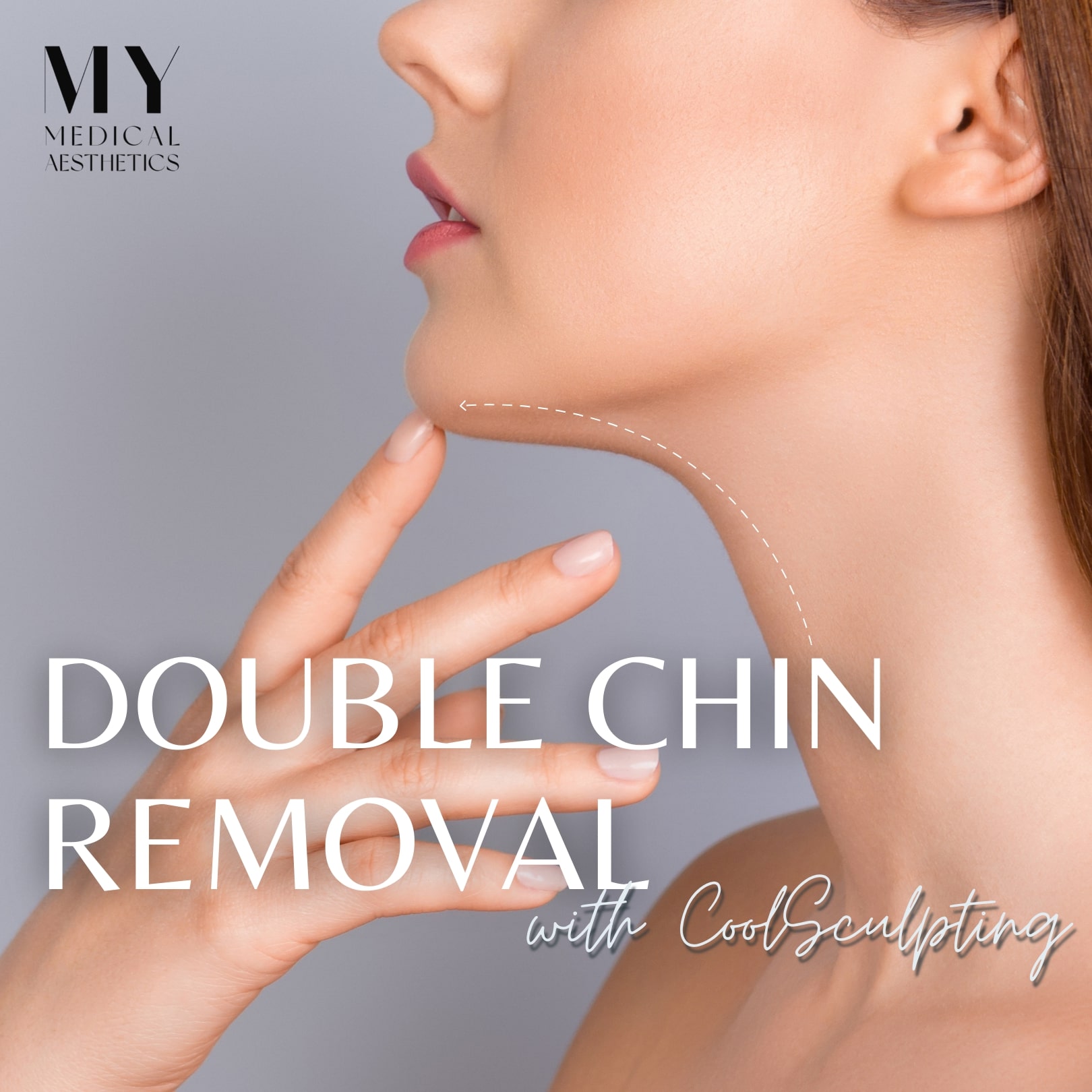My Medical Aesthetic Double Chin Removal